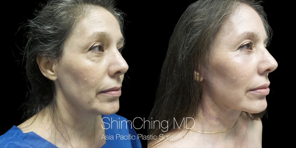Necklift Before & After Gallery - Patient 38290625 - Image 3