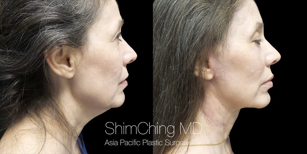 Necklift Before & After Gallery - Patient 38290625 - Image 4