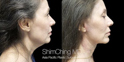 Necklift Before & After Gallery - Patient 38290625 - Image 4