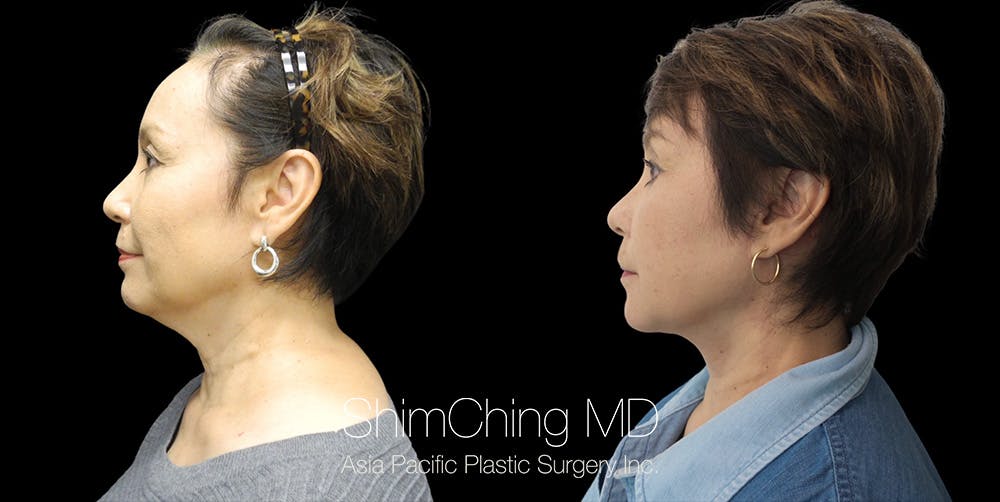 Necklift Before & After Gallery - Patient 38290633 - Image 2