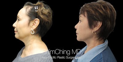 Necklift Before & After Gallery - Patient 38290633 - Image 2