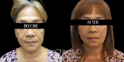 Necklift Before & After Gallery - Patient 148498810 - Image 1