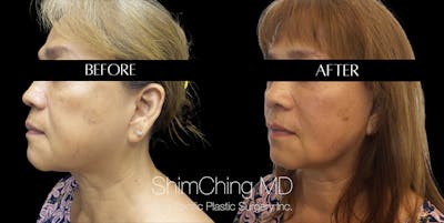 Neck Lift Before & After Gallery - Patient 148498810 - Image 4
