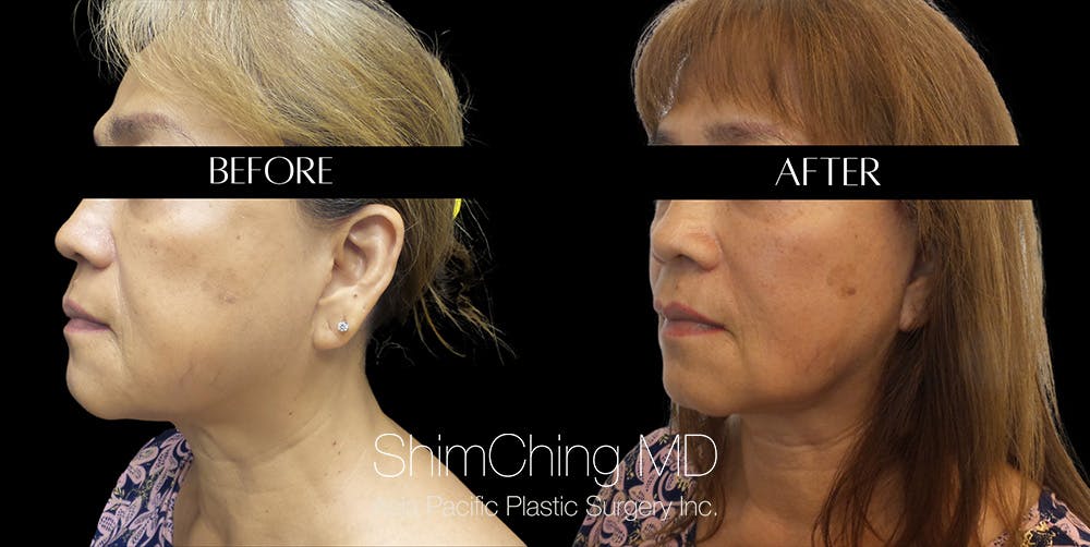 Necklift Before & After Gallery - Patient 148498810 - Image 3
