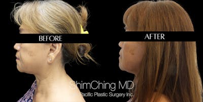 Necklift Before & After Gallery - Patient 148498810 - Image 4