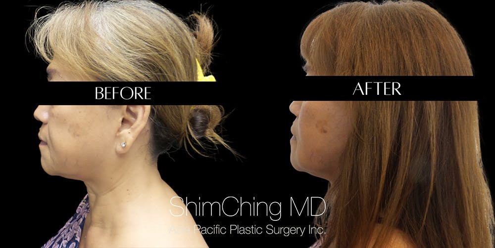 Necklift Before & After Gallery - Patient 148498810 - Image 4
