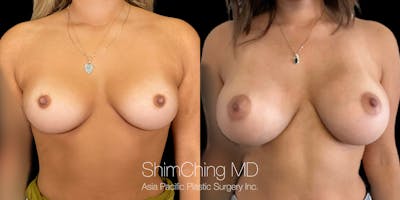 Breast Augmentation Before & After Gallery - Patient 151884991 - Image 1