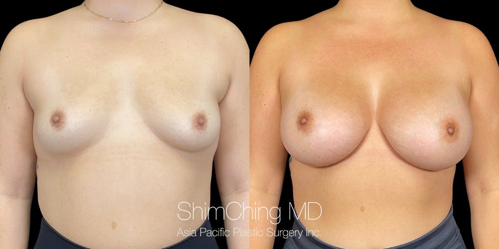 Breast Augmentation Before & After Gallery - Patient 151884994 - Image 1
