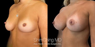 Breast Augmentation Before & After Gallery - Patient 151884991 - Image 2