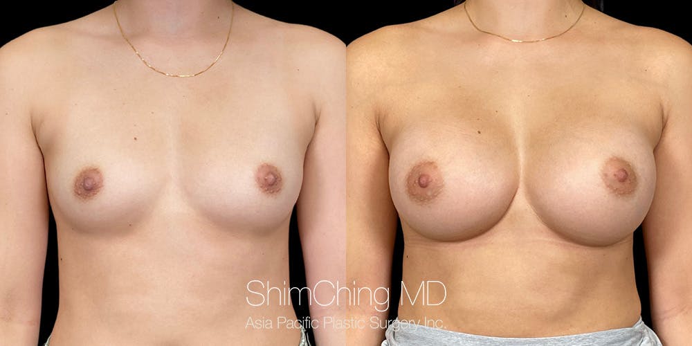 Breast Augmentation Before & After Gallery - Patient 151884975 - Image 1
