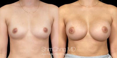 Breast Augmentation Before & After Gallery - Patient 151884975 - Image 1