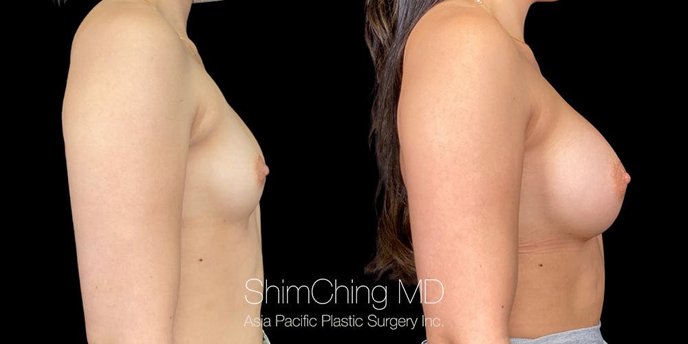 Breast Augmentation Before & After Gallery - Patient 151884975 - Image 3