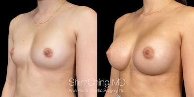 Breast Augmentation Before & After Gallery - Patient 151884975 - Image 2
