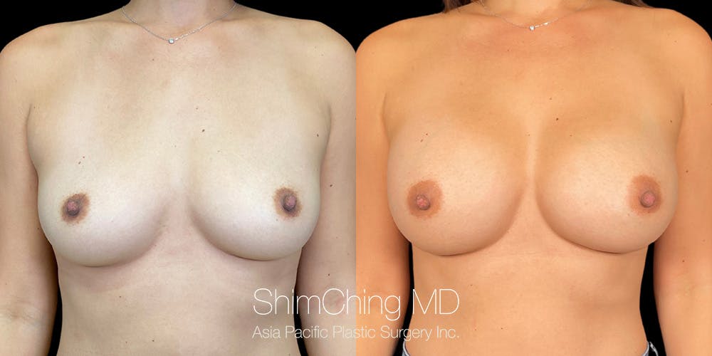 Breast Augmentation Before & After Gallery - Patient 151884979 - Image 1