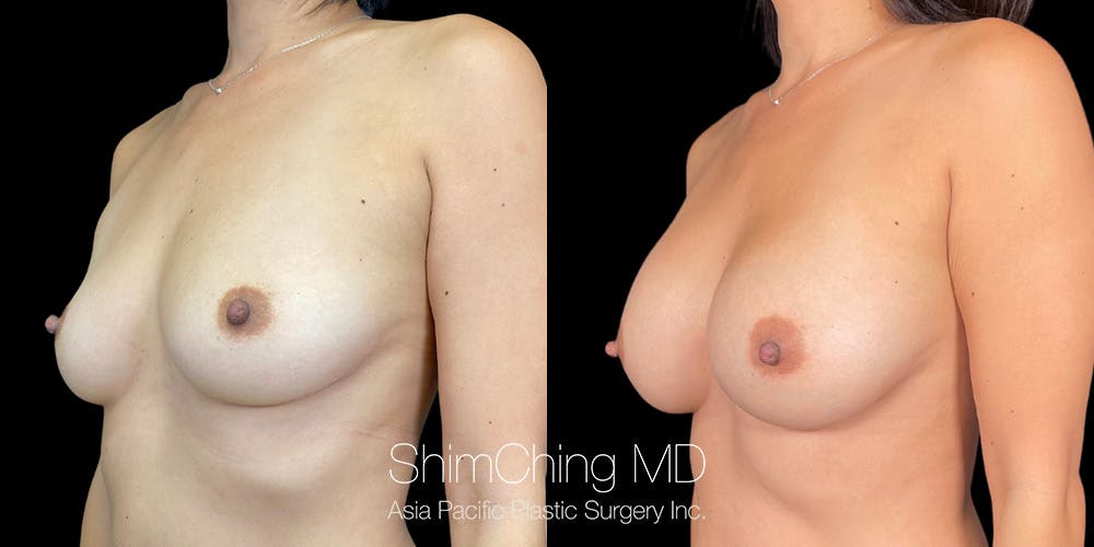 Breast Augmentation Before & After Gallery - Patient 151884979 - Image 3