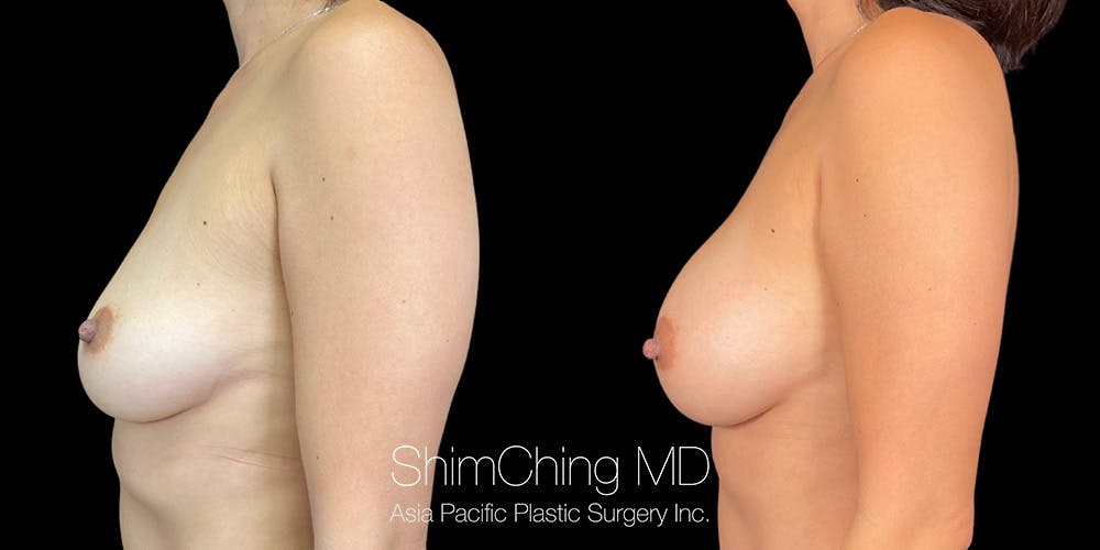 Breast Augmentation Before & After Gallery - Patient 151884979 - Image 4