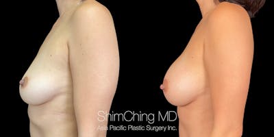 Breast Augmentation Before & After Gallery - Patient 151884979 - Image 4