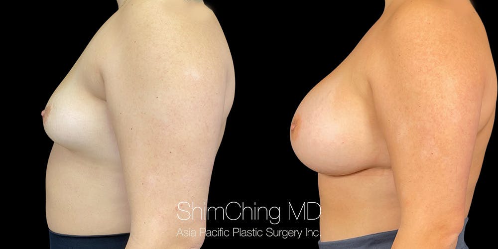 Breast Augmentation Before & After Gallery - Patient 151884994 - Image 3