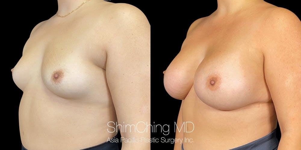 Breast Augmentation Before & After Gallery - Patient 151884994 - Image 2