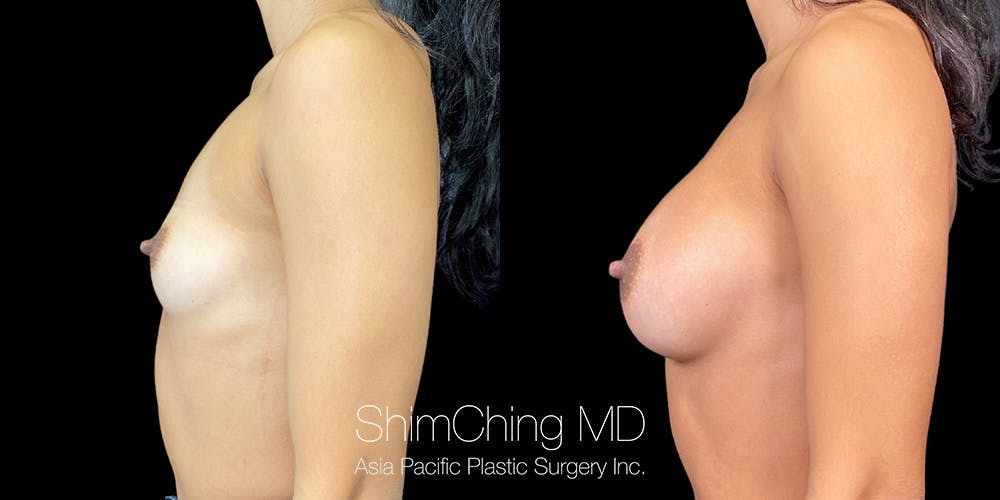 Breast Augmentation Before & After Gallery - Patient 151884999 - Image 3