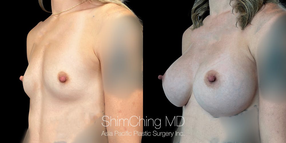 Breast Augmentation Before & After Gallery - Patient 151885079 - Image 2