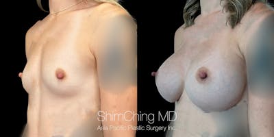 Breast Augmentation Before & After Gallery - Patient 151885079 - Image 2
