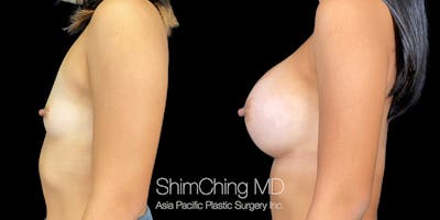 Breast Augmentation Before & After Gallery - Patient 151884968 - Image 4