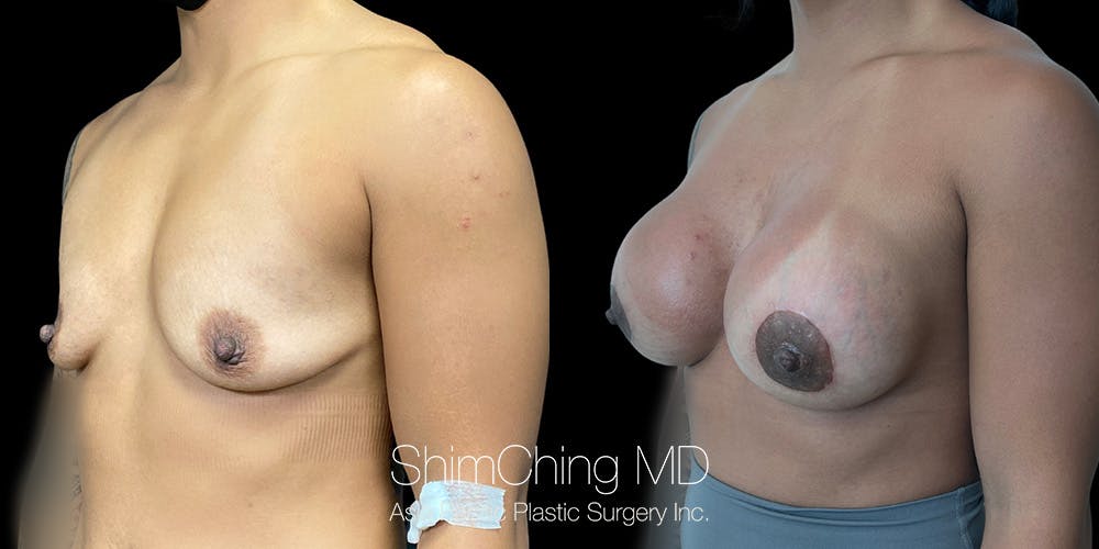 HALO Lift Before & After Gallery - Patient 151885085 - Image 2
