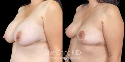 Breast Implant Removal Before & After Gallery - Patient 151885091 - Image 2