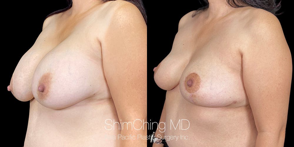 Breast Implant Removal Before & After Gallery - Patient 151885091 - Image 2