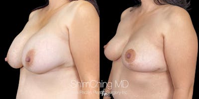 Breast Lift Before & After Gallery - Patient 151885089 - Image 2