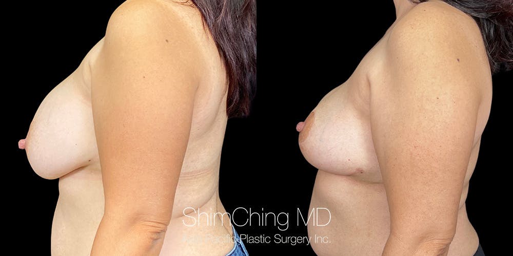 Breast Lift Before & After Gallery - Patient 151885089 - Image 3