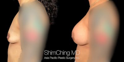 Asian Breast Implants Before & After Gallery - Patient 217143 - Image 2