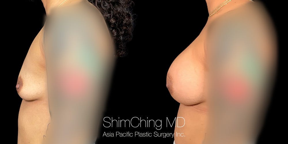 Breast Augmentation Before & After Gallery - Patient 179748113 - Image 2