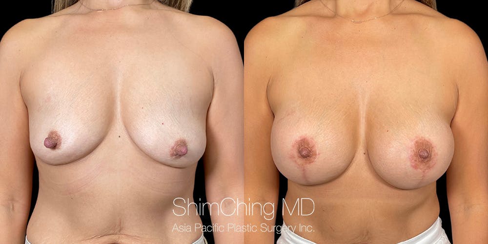 Breast Lift Before & After Gallery - Patient 353543 - Image 1