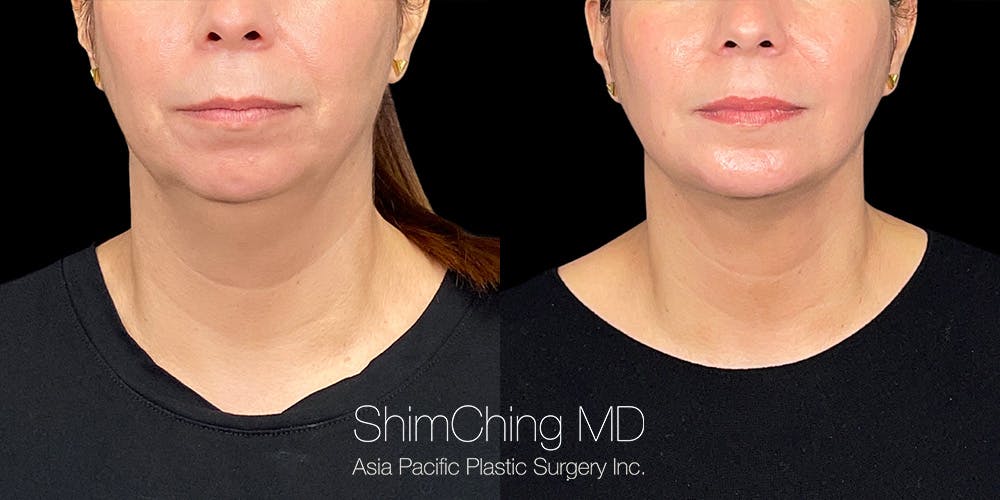 Laser Liposuction Before & After Gallery - Patient 180186472 - Image 3