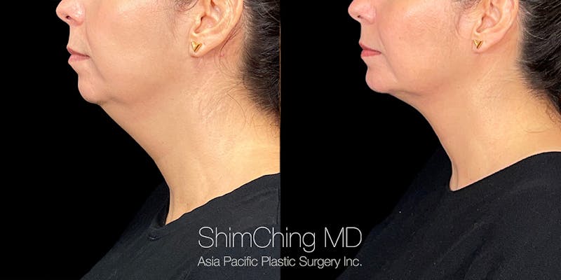 Before and after Liposuction in Hawaii with Dr. Shim Ching