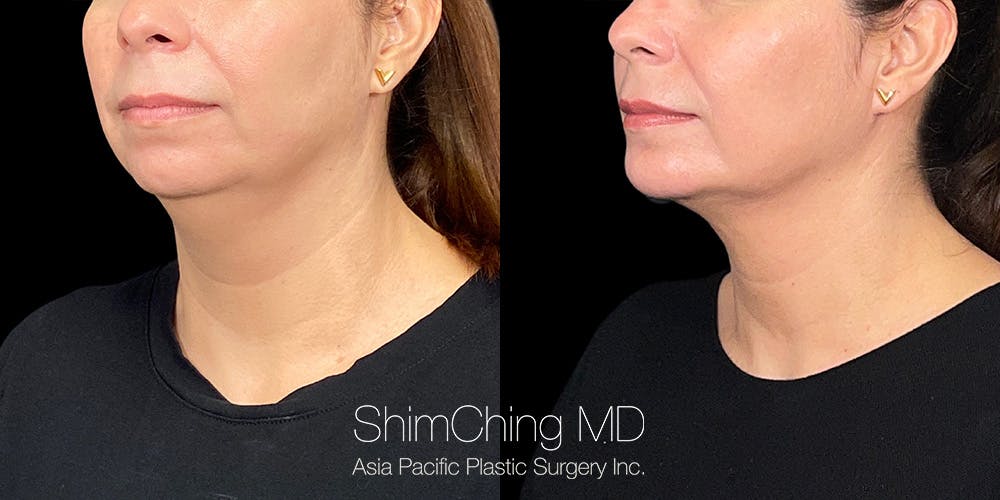 Laser Liposuction Before & After Gallery - Patient 180186472 - Image 2