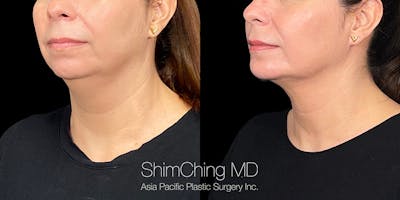 Laser Liposuction Before & After Gallery - Patient 180186472 - Image 2