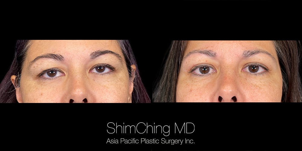 Eyelid Surgery Before & After Gallery - Patient 179752098 - Image 1