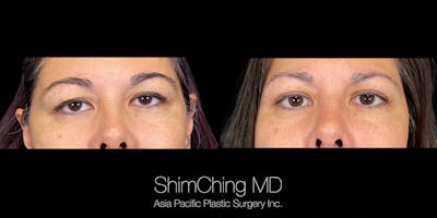 Eyelid Surgery Before & After Gallery - Patient 179752098 - Image 1