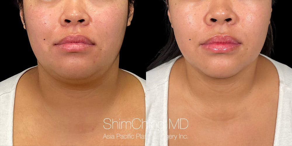 Laser Liposuction Before & After Gallery - Patient 179752149 - Image 1