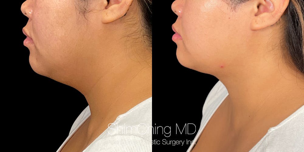 Laser Liposuction Before & After Gallery - Patient 179752149 - Image 3