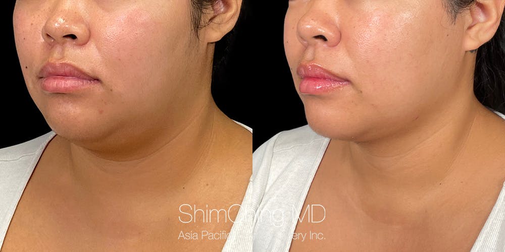 Laser Liposuction Before & After Gallery - Patient 179752149 - Image 2