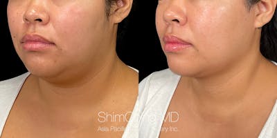 Laser Liposuction Before & After Gallery - Patient 179752149 - Image 2
