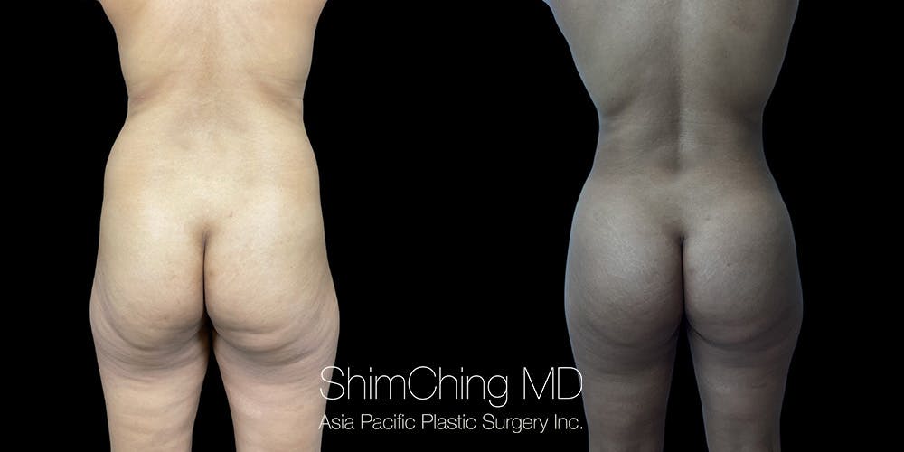 Before and after Liposuction in Honolulu, Hawaii with Dr. Shim Ching