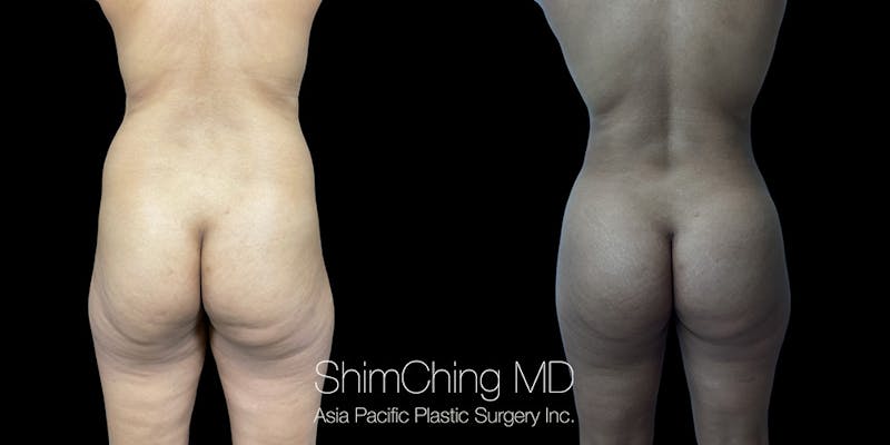 Before and after Liposuction in Honolulu, Hawaii with Dr. Shim Ching