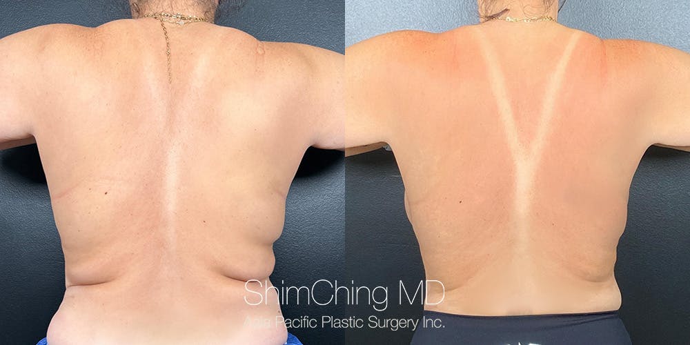 Semaglutide Before & After Gallery - Patient 179754782 - Image 1
