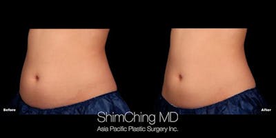 TruSculpt iD Before & After Gallery - Patient 179754873 - Image 1