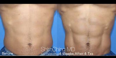 TruSculpt Flex Before & After Gallery - Patient 179755336 - Image 1